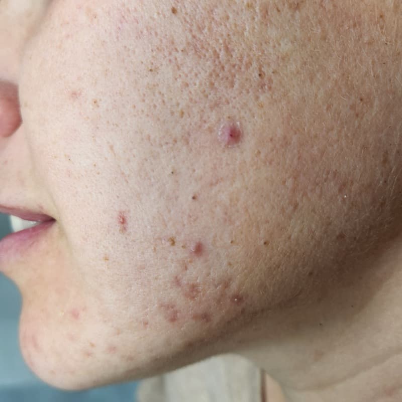 לפני - אקנה וצלקות פוסט אקנה