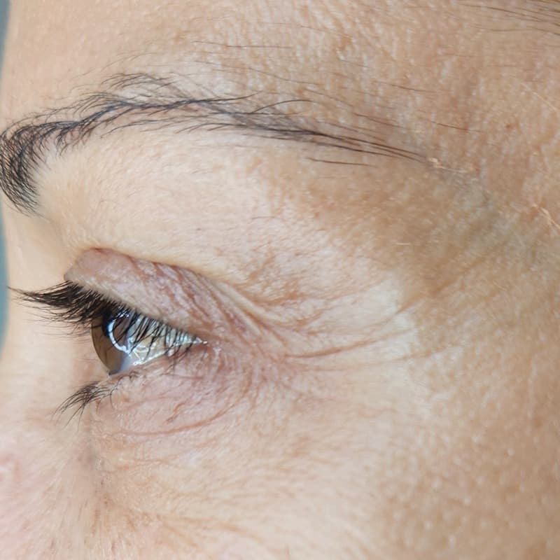 אחרי - הרמת עפעף עליון